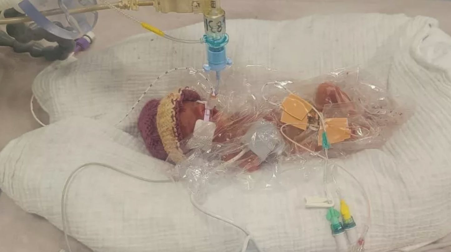 Lille Robyn vejede kun 328 gram, da hun blev født fem måneder før tid. 