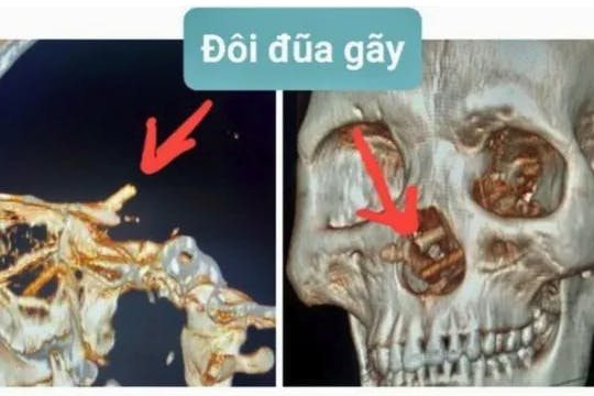 Her ses spisepindene, som blev jaget op i næsen og gennem hjernen.