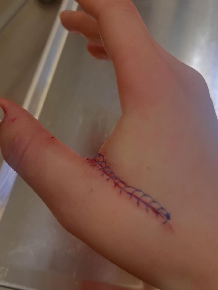 Sådan ser Louise Bachs 17-årige lillesøsters hånd ud, efter skaderne som hun pådrog sig under det voldsomme røveri i en Rema1000.