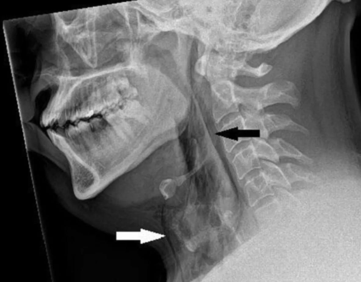Tænk, at man kan komme så voldsomt til skade ved ikke at nyse.