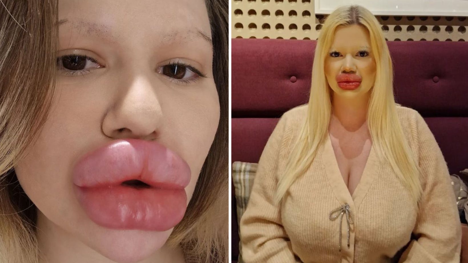 Onde tunger vil mene, at Andrea ligner en, der har valgt behandlinger under kategorien "bistik", men selv er hun ganske selvsikker omkring sine store kunstige læber 