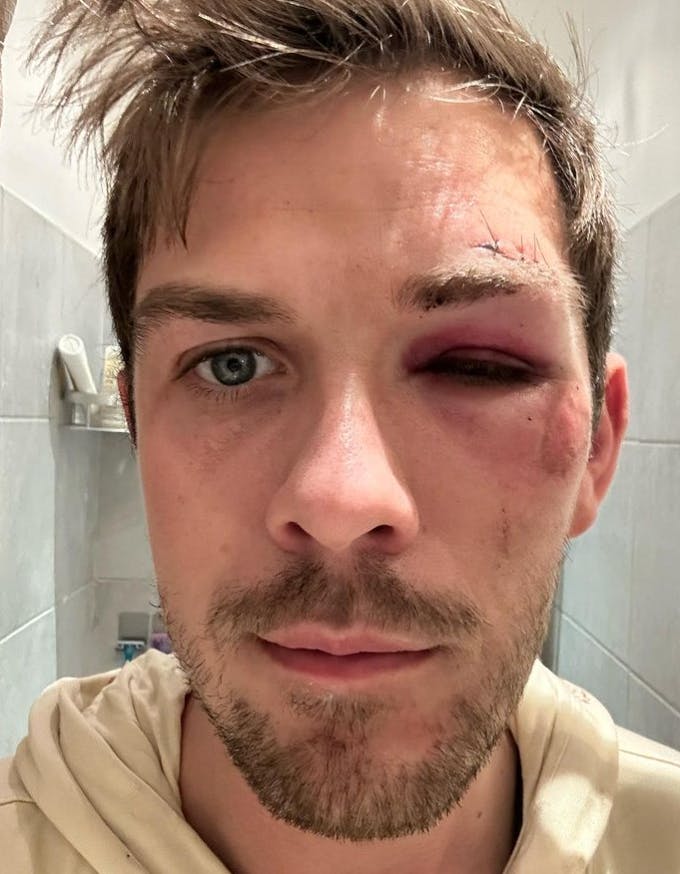 Oliver Stanescu måtte få fire sting i øjenbrynet efter overfaldet.