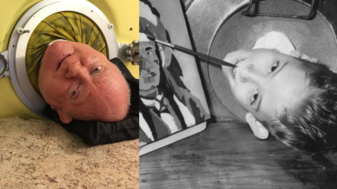 Paul Alexander lå i jernlungen i 72 år.