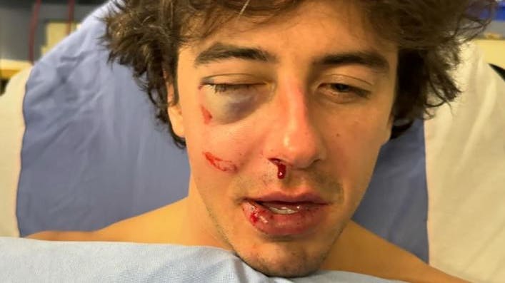 Snowboardstjernen måtte en tur på operationsbordet efter styrtet. 