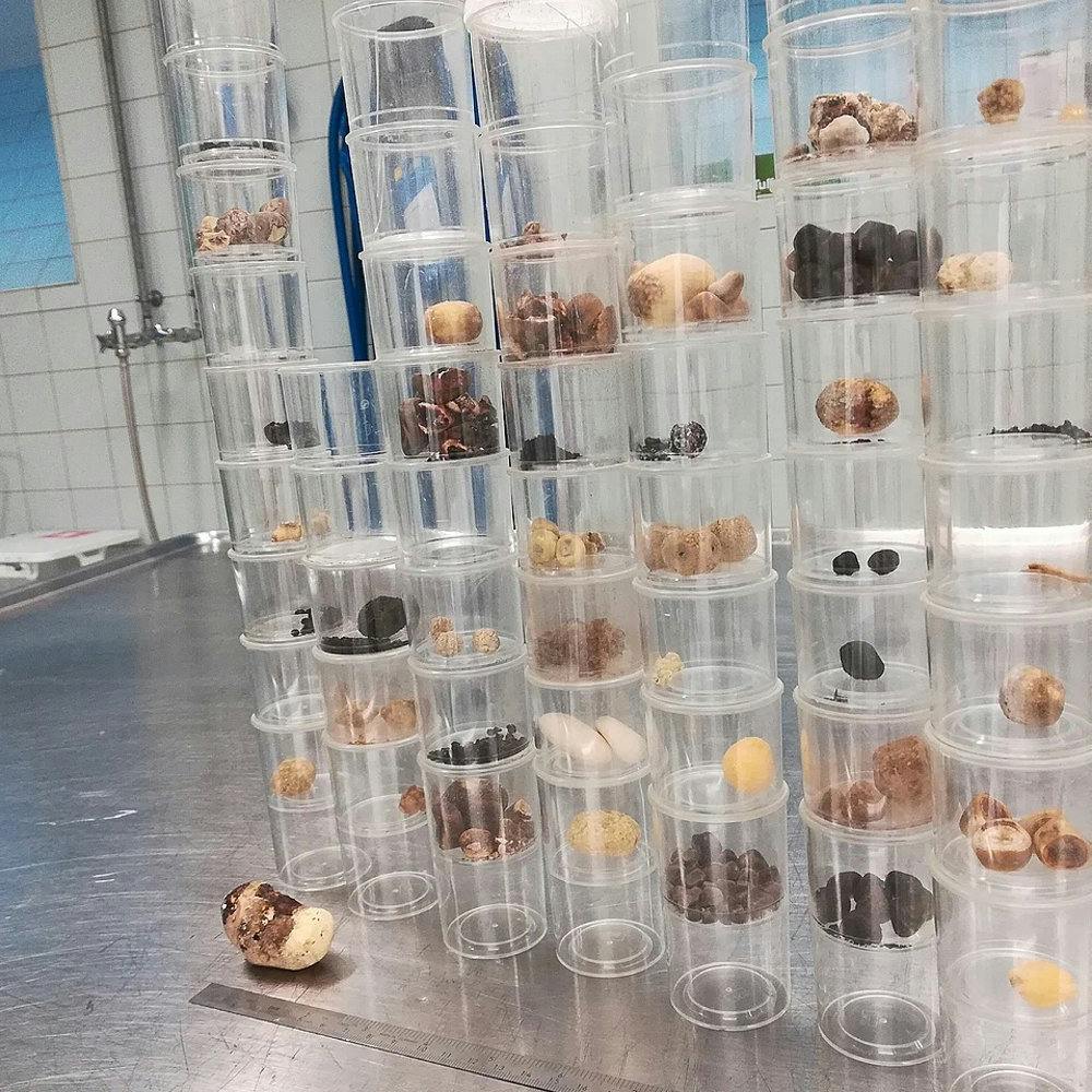 Sten fundet i menneskekroppe under obduktioner.