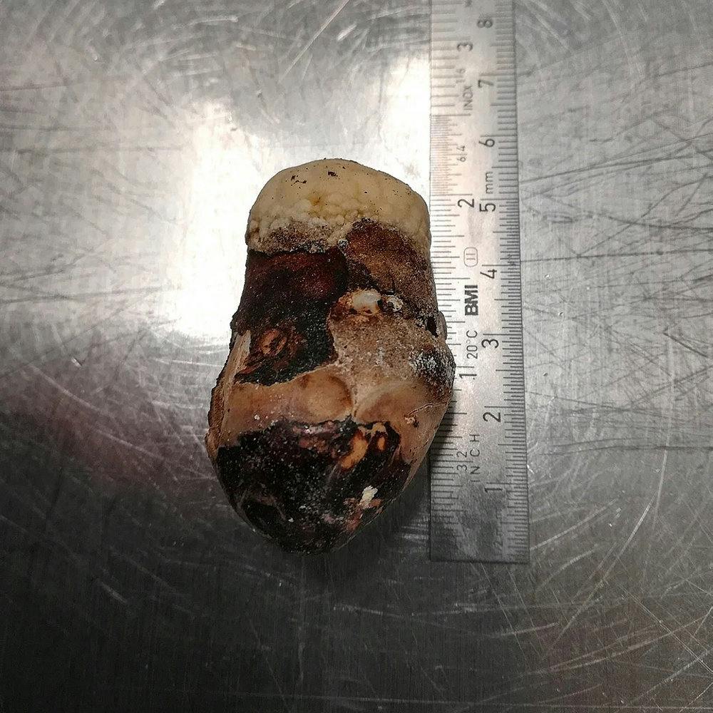 Én af de større sten fundet under en obduktion måler mere end fem centimeter.