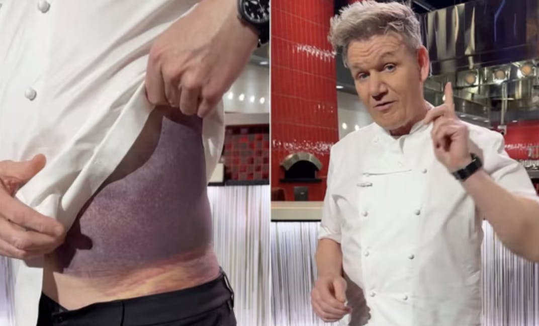 57-årige Gordon Ramsay har fået voldsomme skader på maven efter sin cykelulykke.&nbsp;