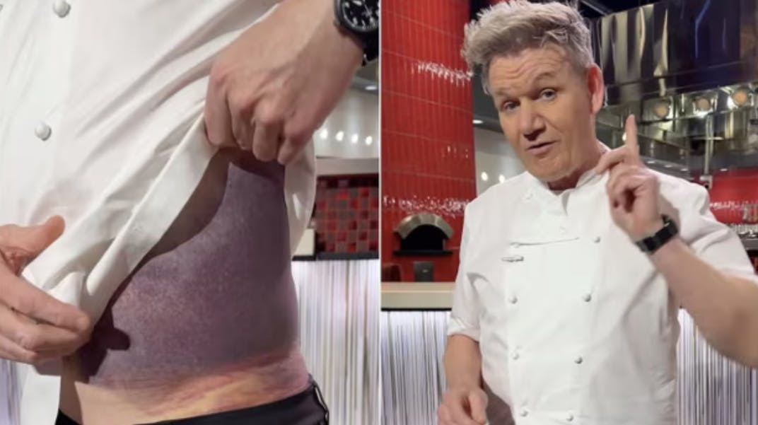 57-årige Gordon Ramsay har fået voldsomme skader på maven efter sin cykelulykke. 