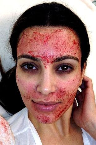Kim Kardashian har tidligere slået fast, at hun aldrig vil få den populære vampyr-ansigtsbehandling igen.