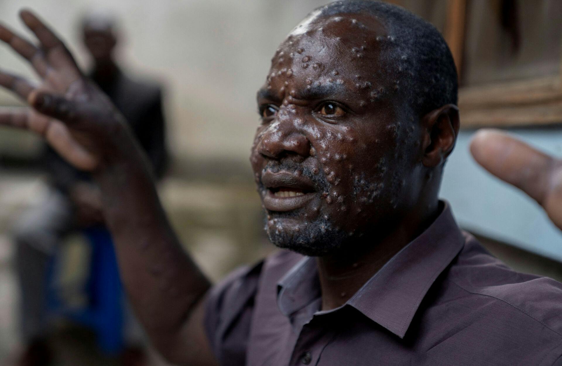Her ses 48-årige Jean Kakuru Biyambo fra DR Congo, som har et alvorligt udbrud af mpox.  