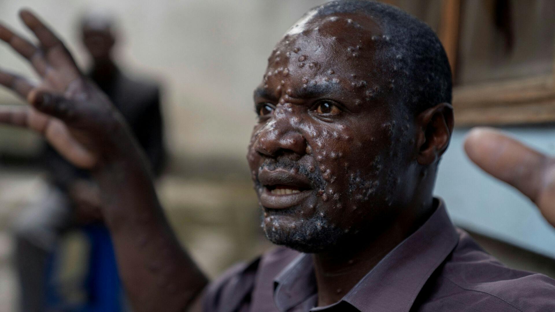 Her ses 48-årige Jean Kakuru Biyambo fra DR Congo, som har et alvorligt udbrud af mpox.