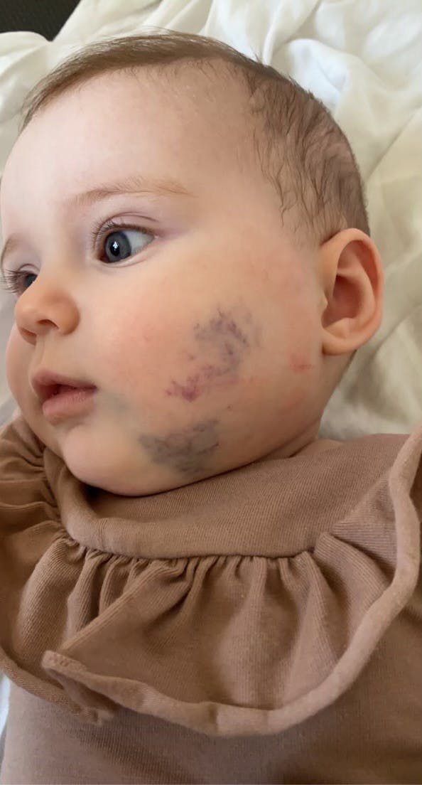 Hailey har haft knuden i kinden, siden hun var helt lille. – Det er en misdannelse i venerne, lidt som et garnnøgle. Hendes vener er helt kludrede sammen, forklarer Nana og uddyber: – Den sad i halsen. Det fik vi ikke at vide til at begynde med – der fik vi at vide, at det kun var kosmetisk. Men i halsen er det livstruende. Der ramlede vores verden.