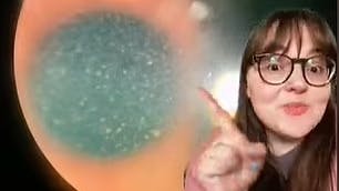 Lægen fandt skadelige parasitter i stakkels Emily Kellehers øje.