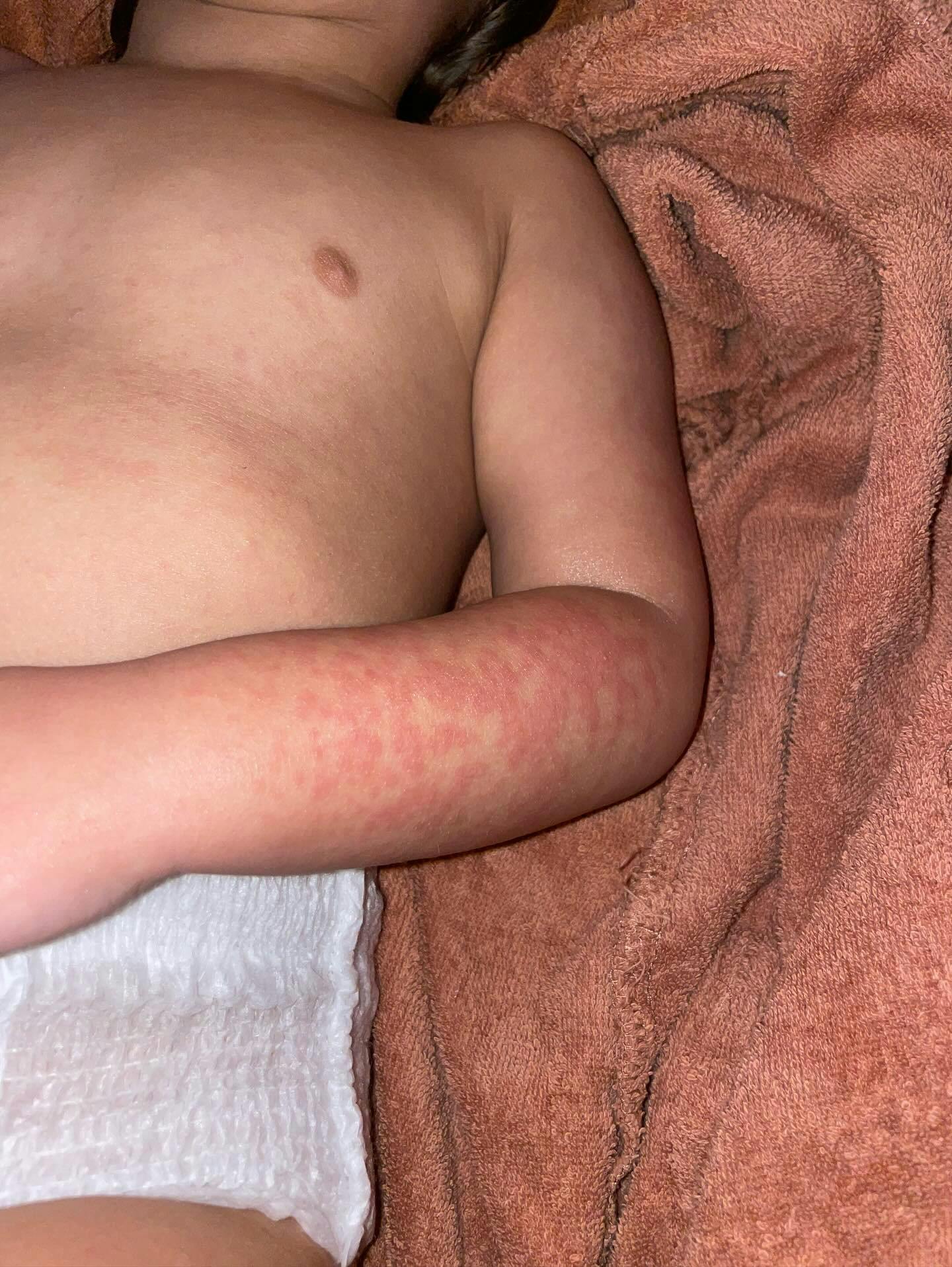 Det seneste år har Joys datter haft adskillige udslæt på kroppen og astmaanfald.