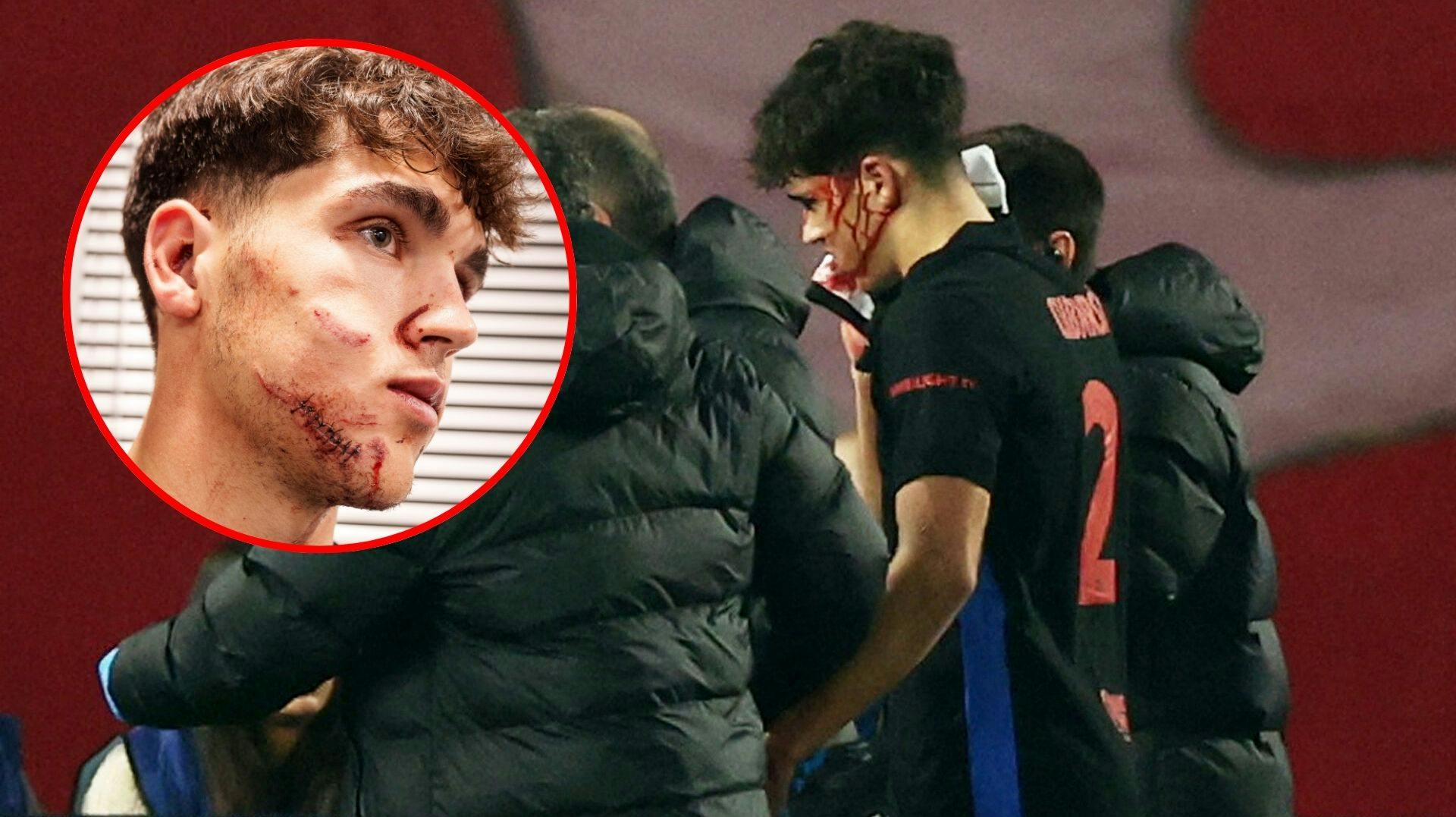Pau Cubarsi kom slemt til skade i gårsdagens kamp mod Røde Stjerne. FC Barcelona-stjernen er efterfølgende blevet syet med 10 sting.