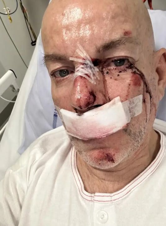 Kenny Jensen vågnede op til et skræmmende syn på hospitalet. SE og HØR har fået tilladelse til at bringe billedet.&nbsp;