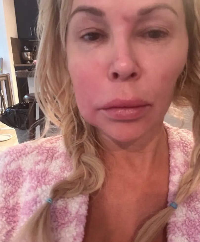 Brandi Glanville blev indlagt i oktober sidste år, da ansigtsproblemerne begyndte.