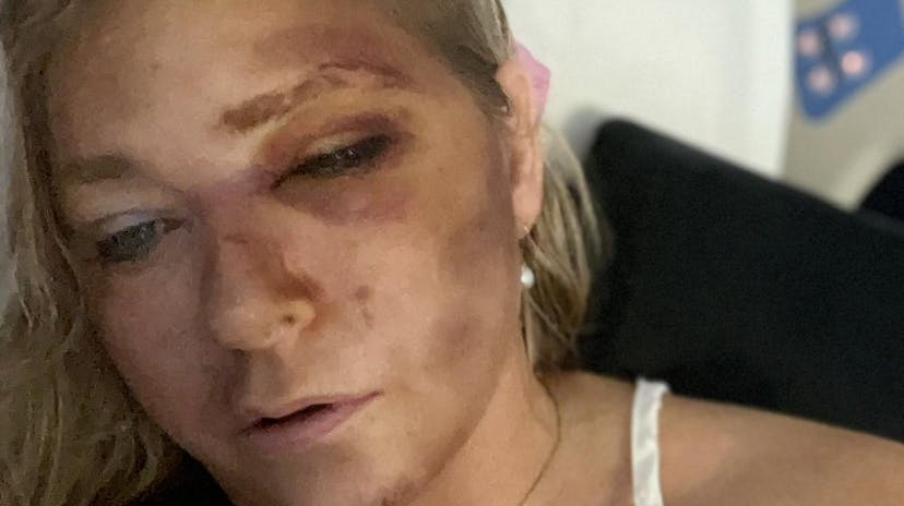 Sådan ser Virgina Giuffres skader ud.