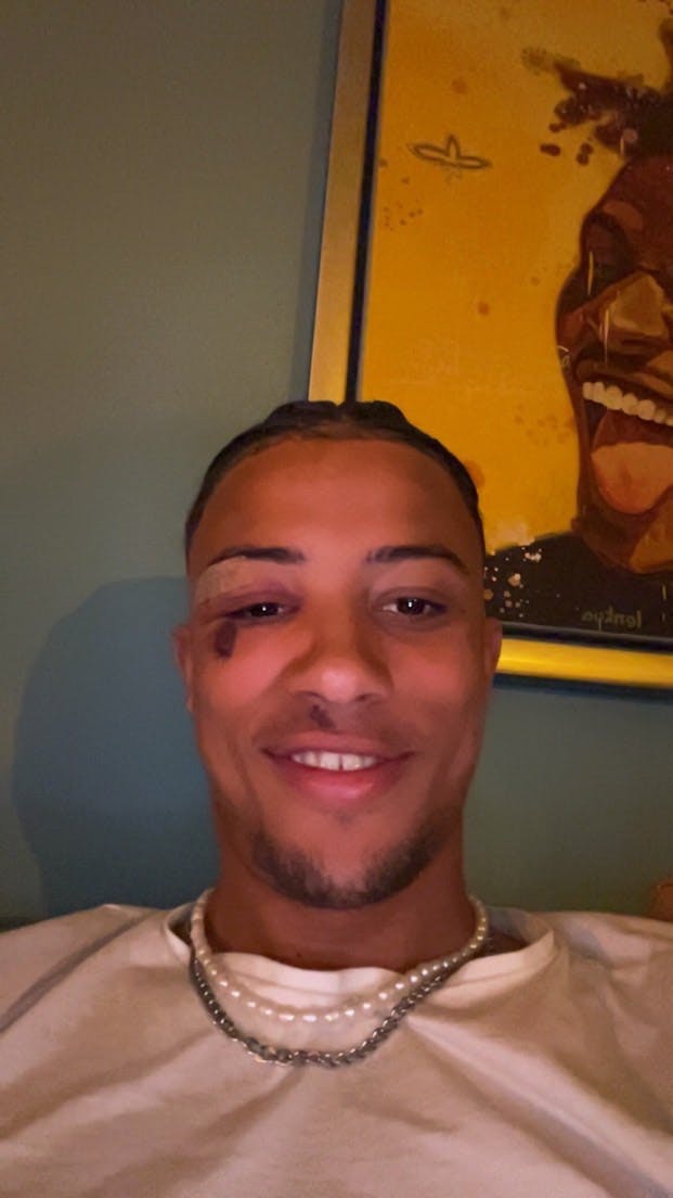 Elijah Spears har tydelige mærker i hovedet efter overfaldet.