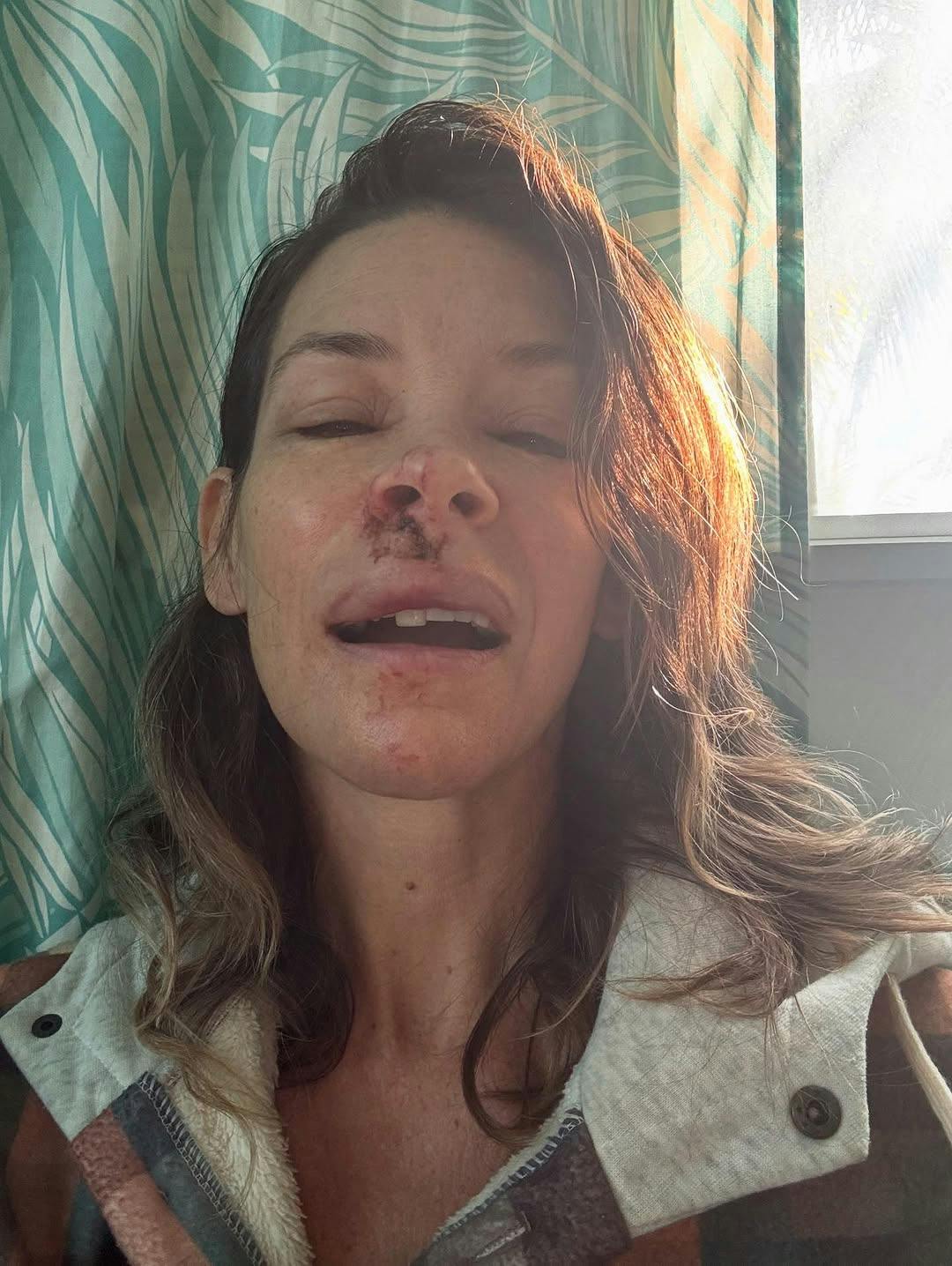 Evangeline Lilly viser de voldsomme skader i ansigtet efter sit mystiske blackout på stranden.