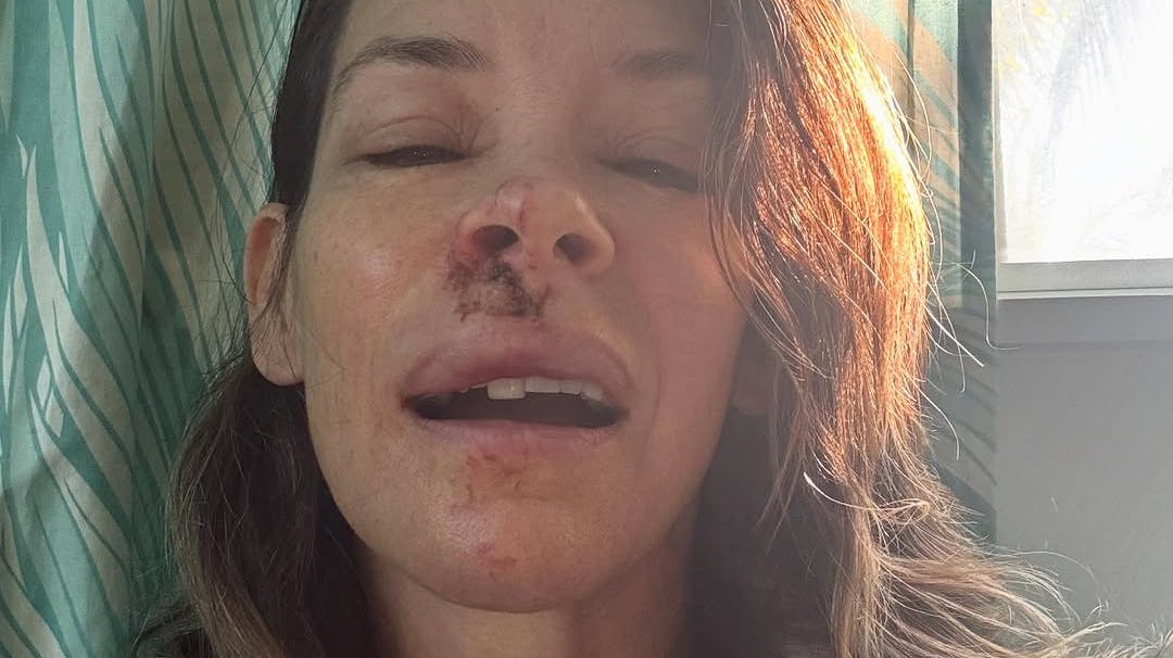 Evangeline Lilly viser de voldsomme skader i ansigtet efter sit mystiske blackout på stranden.