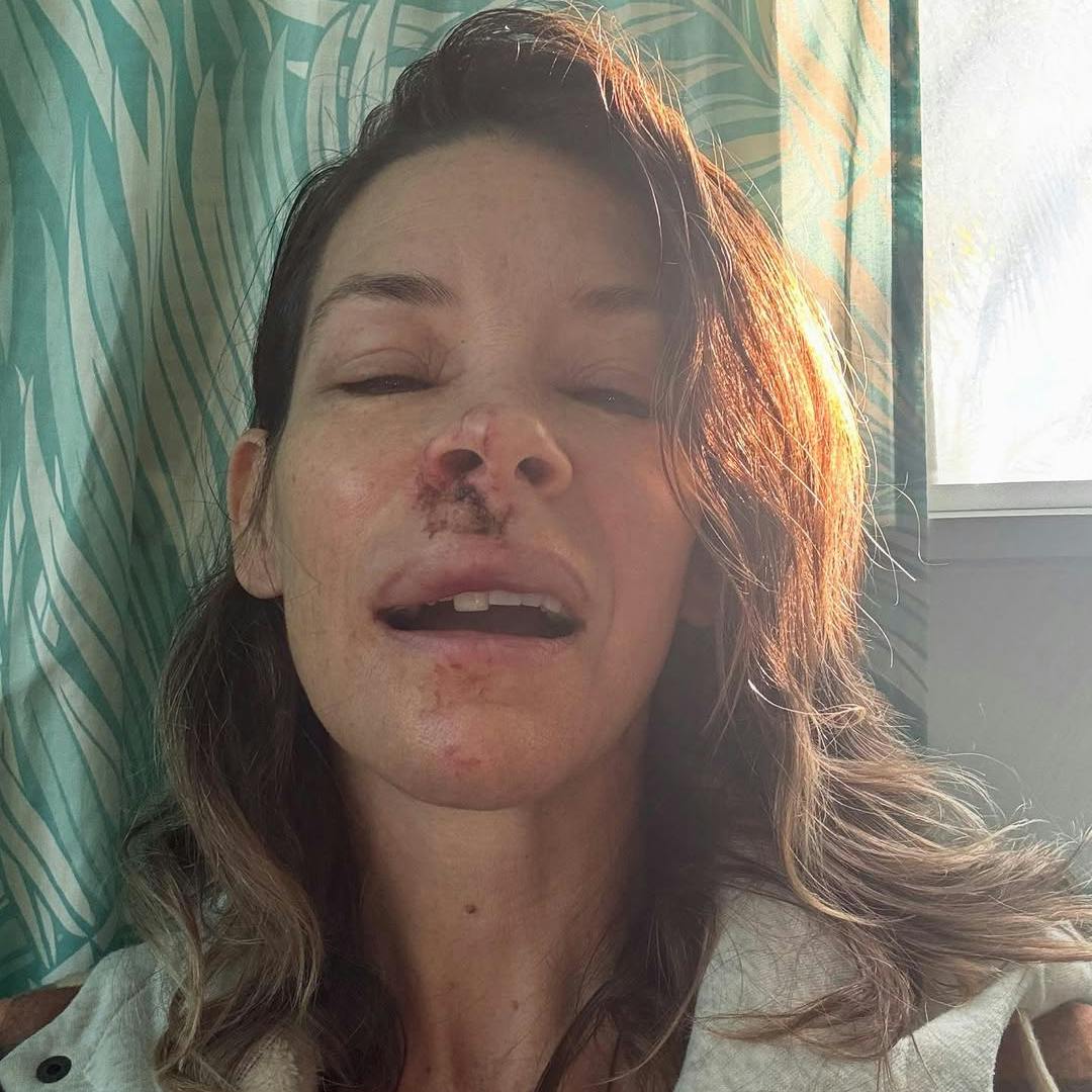 Evangeline Lilly viser de voldsomme skader i ansigtet efter sit mystiske blackout på stranden.