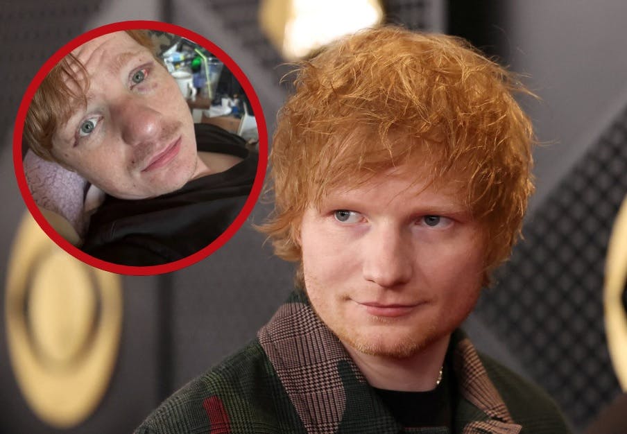 Ed Sheeran-lookaliken Ty Jones blev tæsket på festival af folk, der troede, han var den britiske sanger.