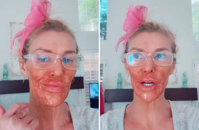 Brandi Glanville viser sine skader frem.