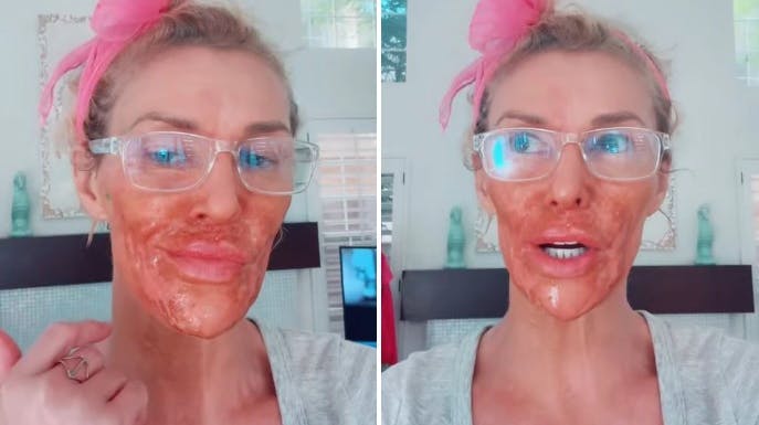 Brandi Glanville viser sine skader frem.
