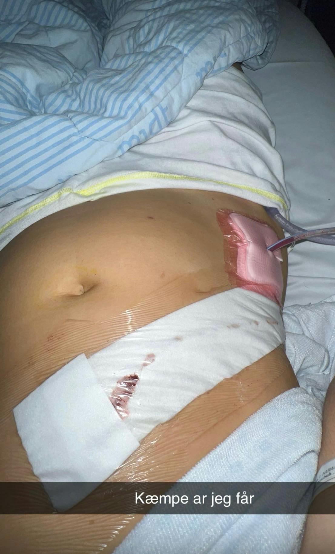Amalie blev opereret i december 2023, året efter tog hun til "Love Island" for at finde kærligheden.
