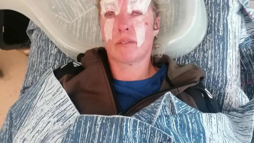 Sådan så Sanne ud, da hun lå på hospitalet efter mødet med syrebomben.