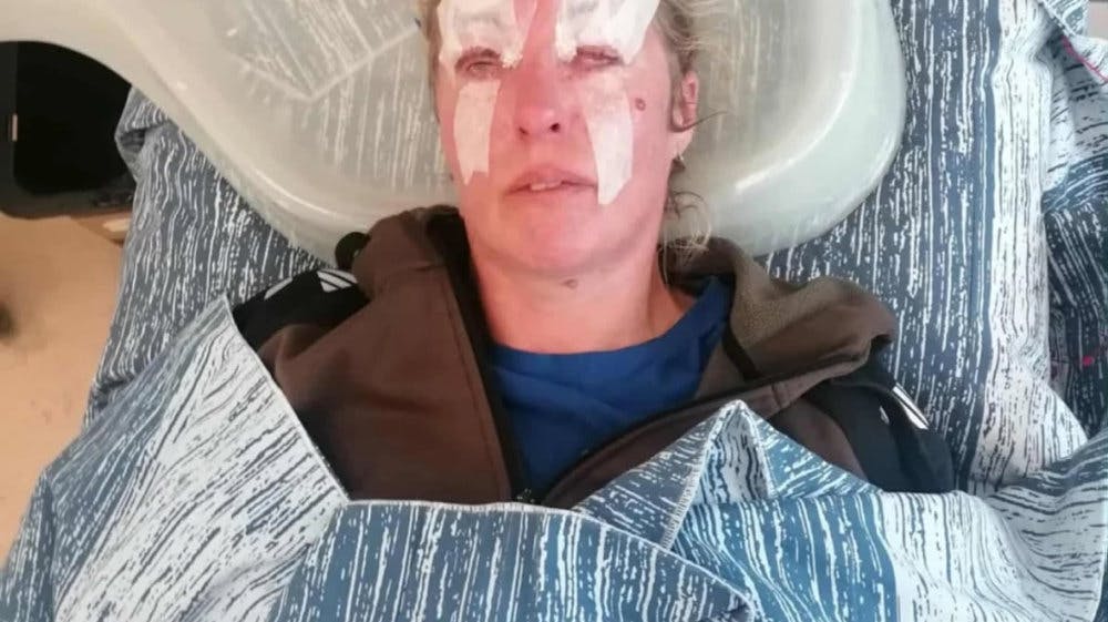 Sådan så Sanne ud, da hun lå på hospitalet efter mødet med syrebomben.