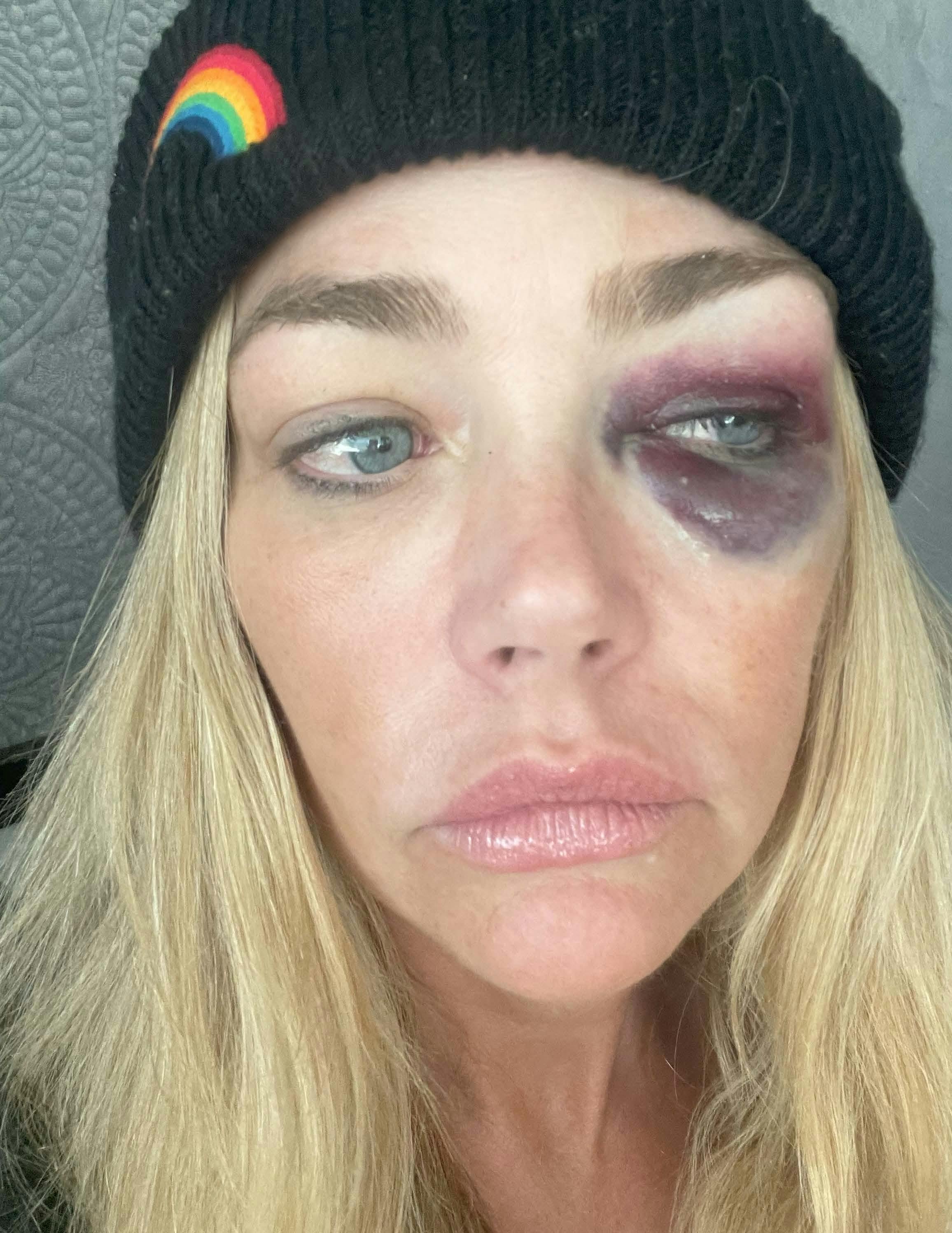 Denise Richards har tidligere delt billeder af skader, som ifølge hende var forårsaget af Aaron Phypers.