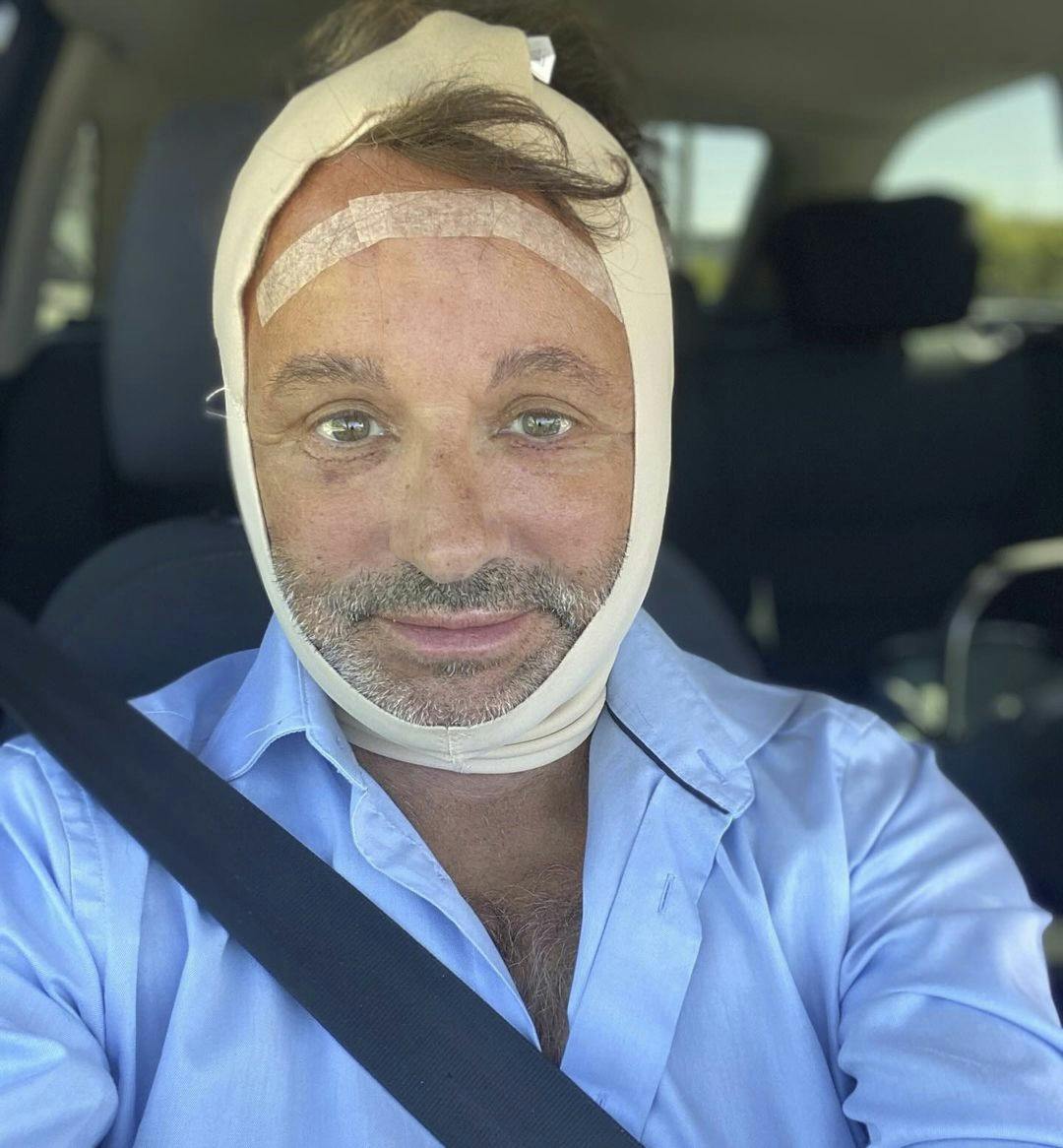 Dennis Knudsen har tidligere fortalt, at han har fået et ansigtsløft til den nette sum af 142.000 kroner.