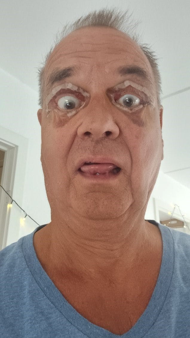 Ole er godt tilfreds med udfaldet af operationen.