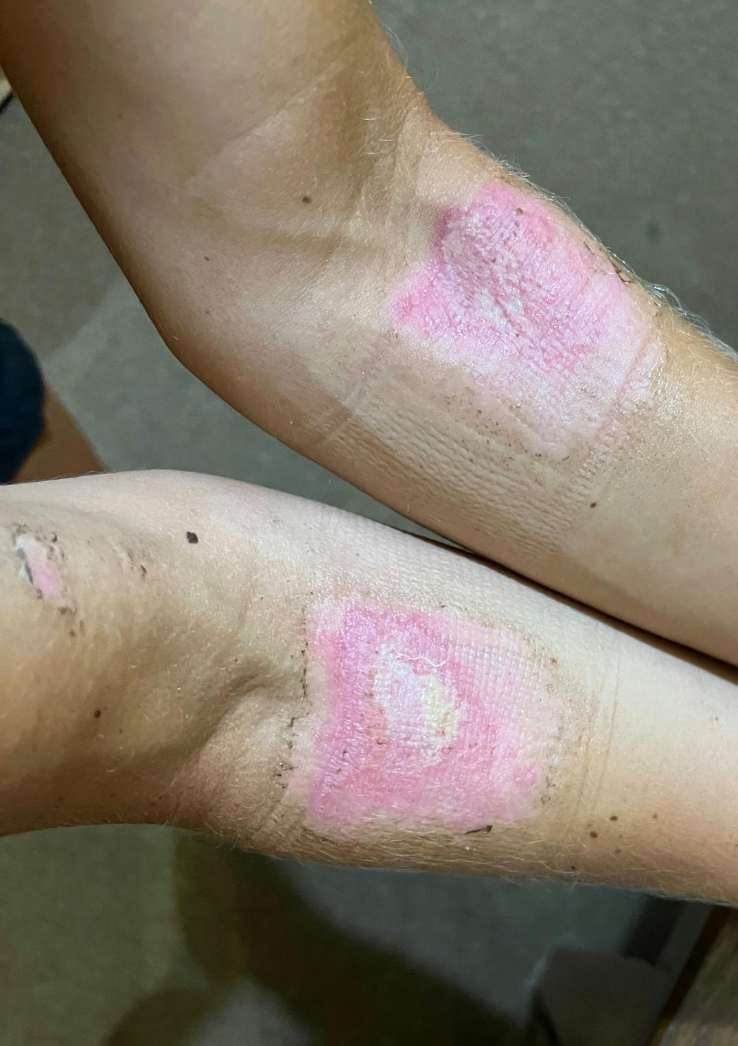 Det var svært for lægerne at få bugt med betændelsen i sårene.