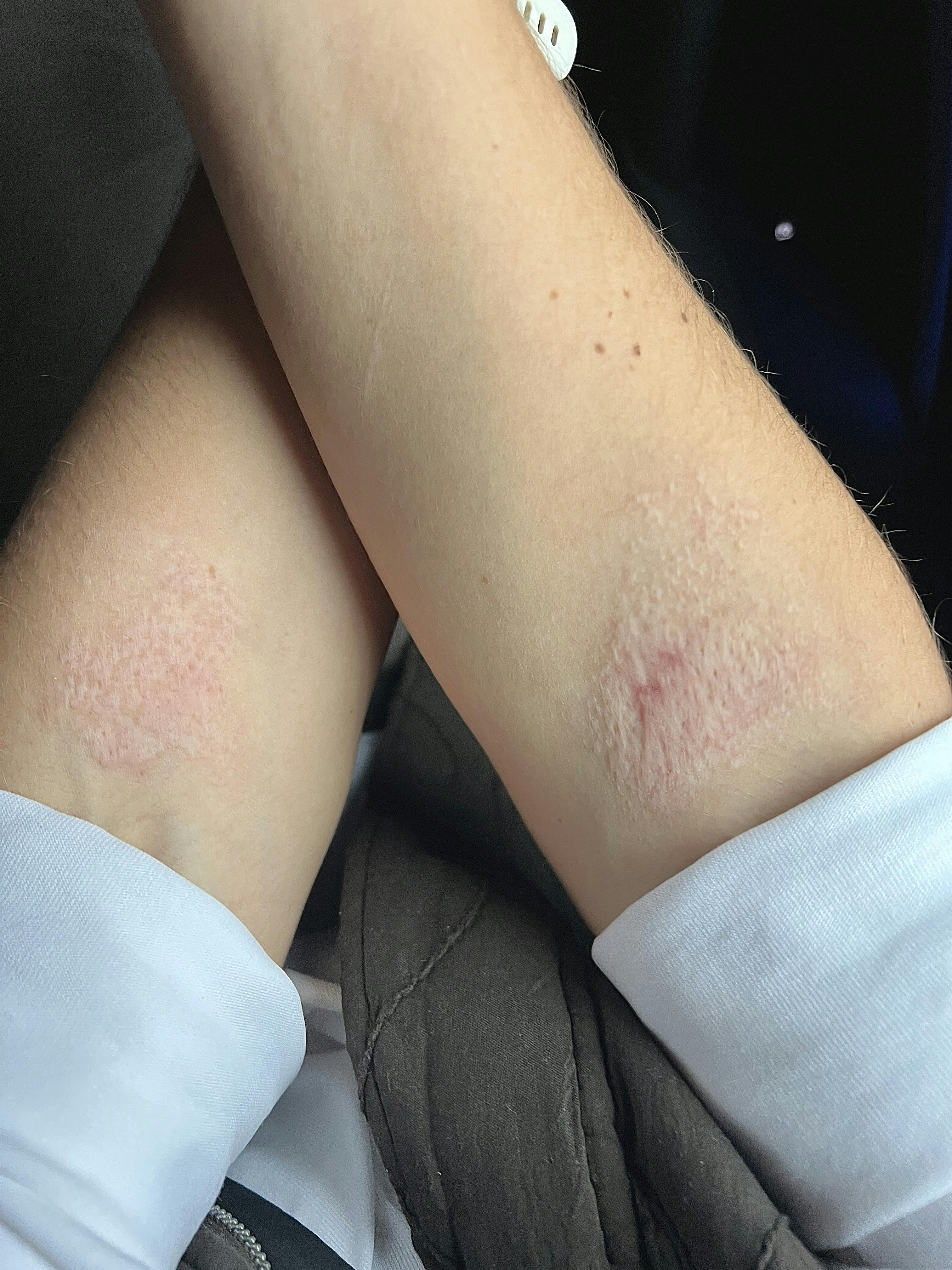 I dag er arene foreviget på Tanjas underarme.