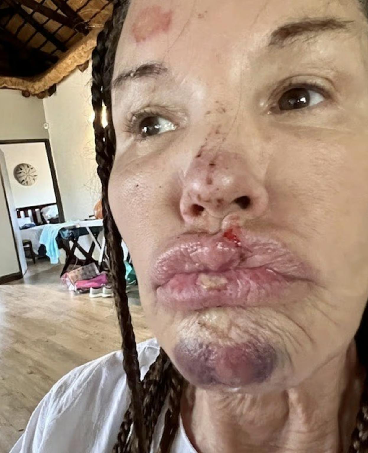 Janice Dickinson mener, at ar og deformiteter efter ulykken ikke kan fjernes med kirurgi.