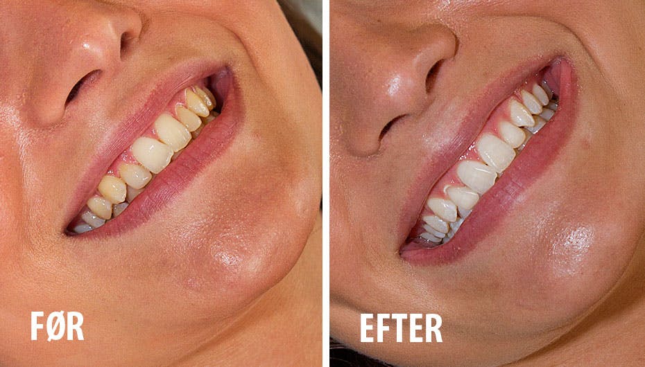 Se hvilken reality-babe der gemmer sig bag dette hvide tandsæt