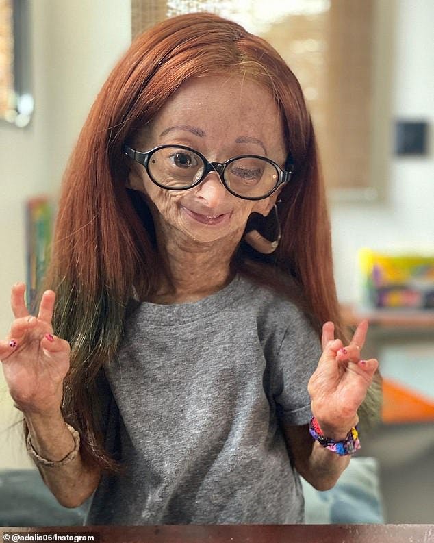 https://imgix.seoghoer.dk/media/article/52902593-10400033-a_15_year_old_girl_who_suffered_from_real_life_benjamin_button_d-a-2_1642111510207.jpg