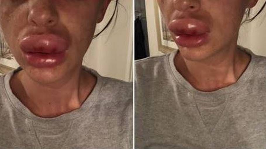 https://imgix.seoghoer.dk/media/article/botox2.jpg