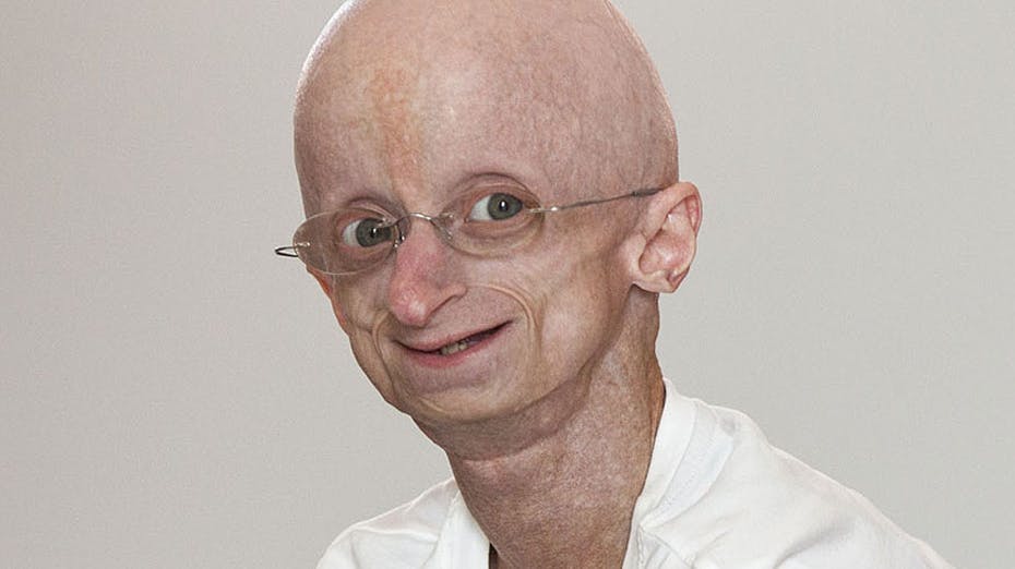 Jesper Sørensen lider af den sjældne sygdom progeria, der får kroppen til at ældes langt hurtigere.