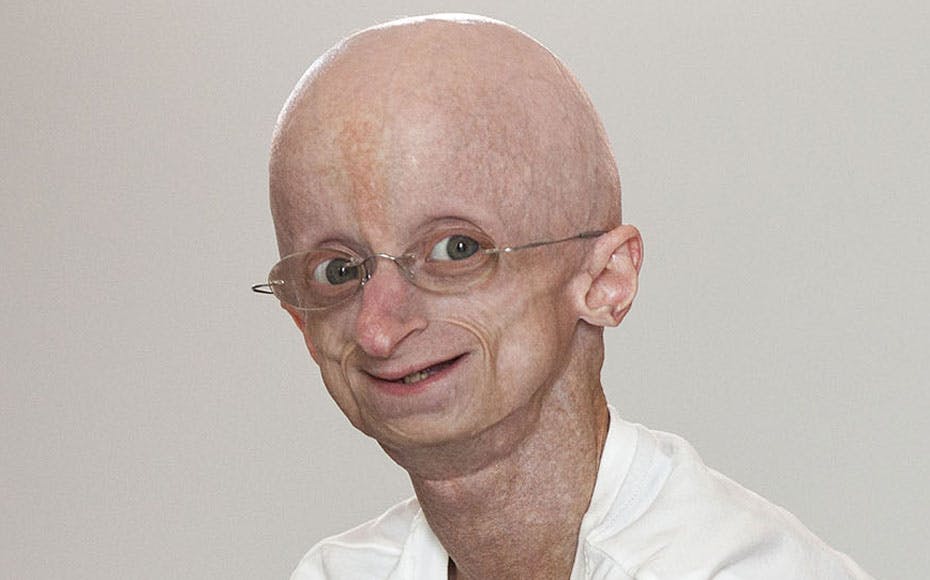 https://imgix.seoghoer.dk/media/article/jesper_soerensen_progeria.jpg