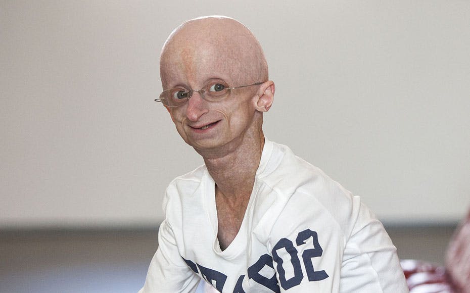 https://imgix.seoghoer.dk/media/article/progeria_jesper.jpg