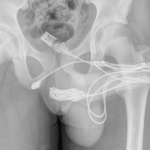 https://imgix.seoghoer.dk/media/article/usb-cord-stuck-in-penis-hp.jpg
