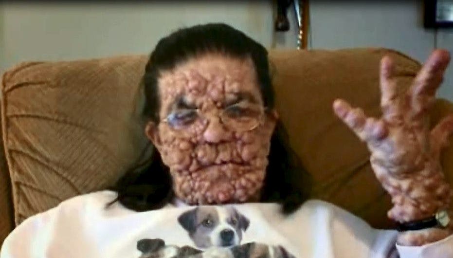 Charlottes sygdom er blevet værre over årene