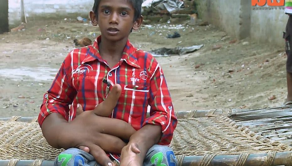 Kaleems hænder vejer hver otte kilo - og de indiske læger kan ikke forklare hvorfor