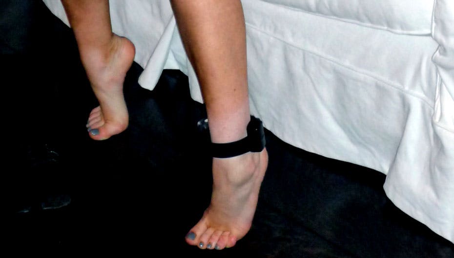 Hvilken kendis viser stolt sin fodlænke OG sit misfarvede ben frem?