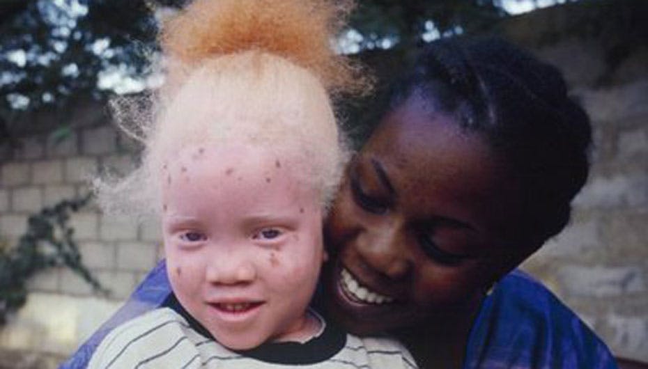Det er ret svært ikke at blive bemærket, når man er født som albino i Afrika