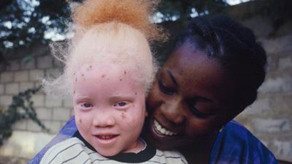 Det er ret svært ikke at blive bemærket, når man er født som albino i Afrika